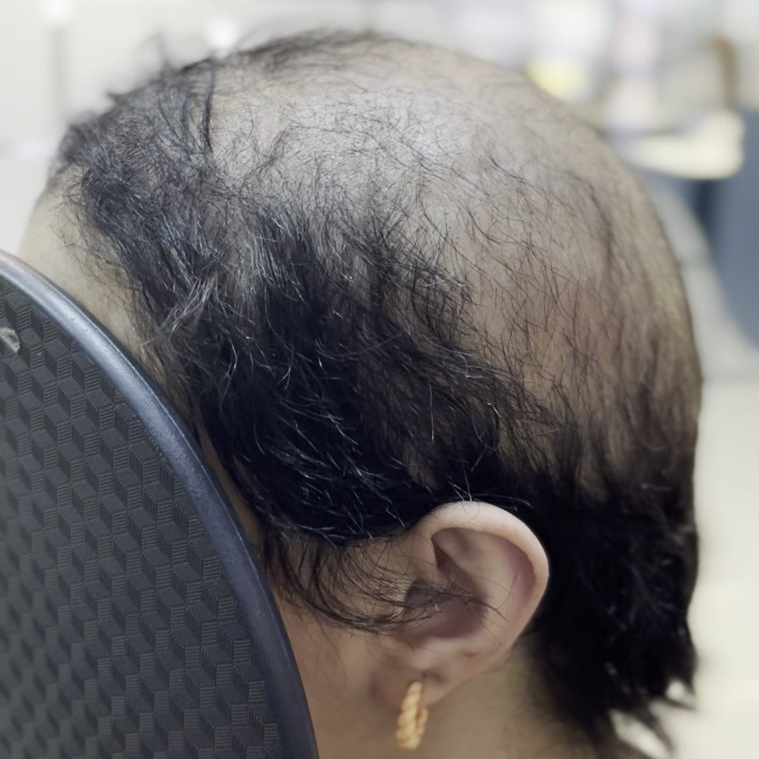 A young woman with alopecia smiling and looking at the camera.